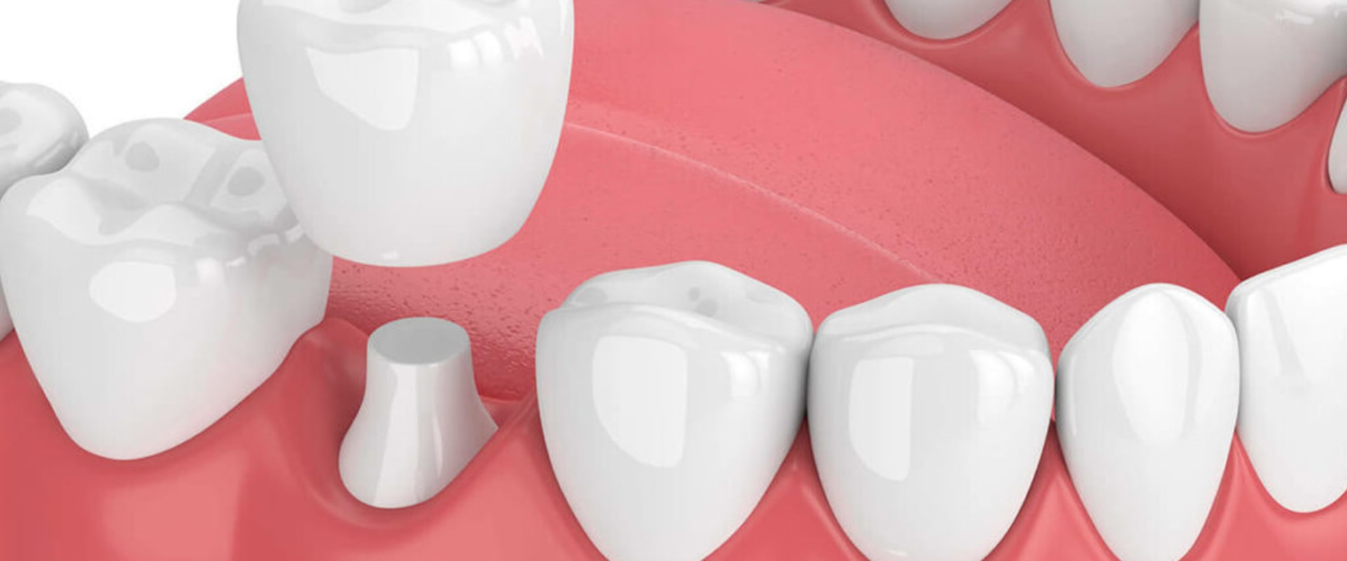 Crowns and Bridges: An Overview