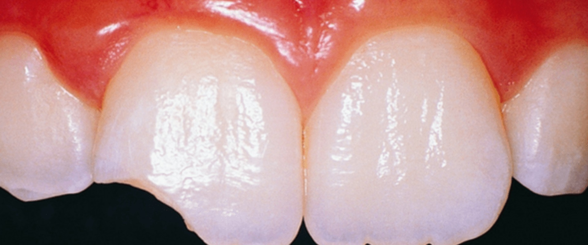 Everything You Need to Know About Injury or Trauma to the Tooth