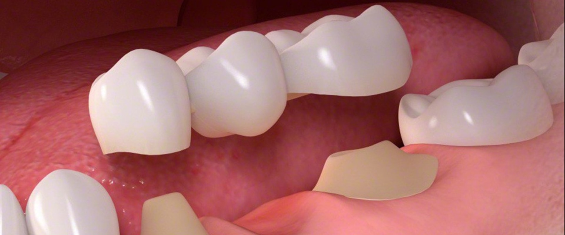 Placement of Abutment: A Comprehensive Overview