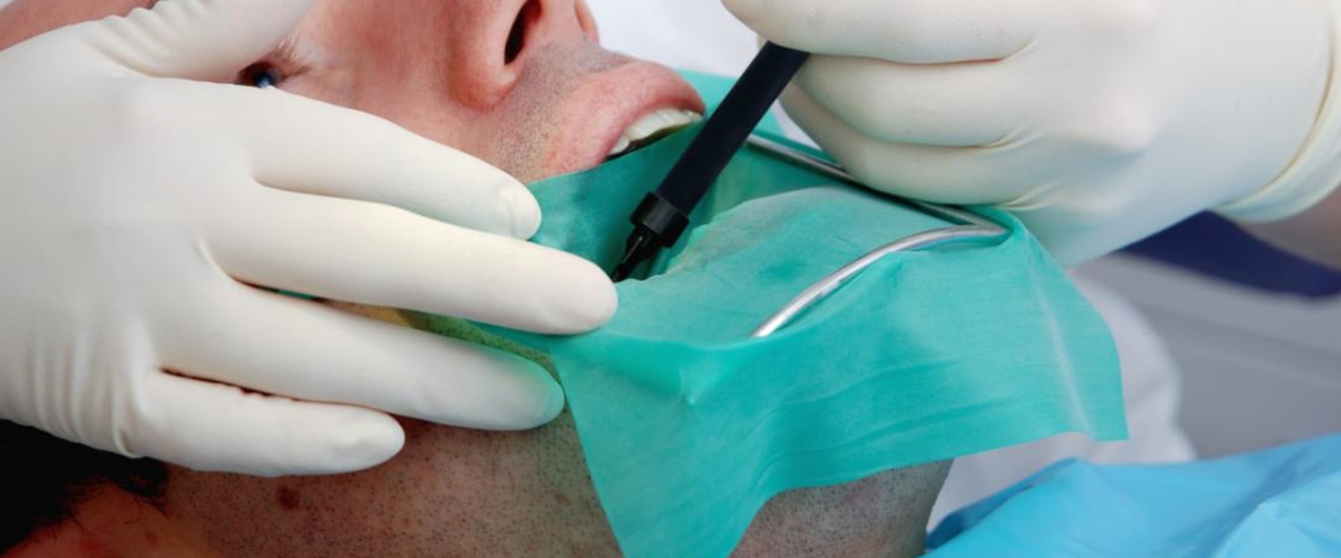 Caring for the Wound After a Root Canal Treatment
