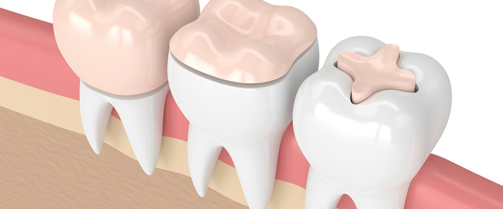 Everything You Need to Know About Fillings and Dental Inlays