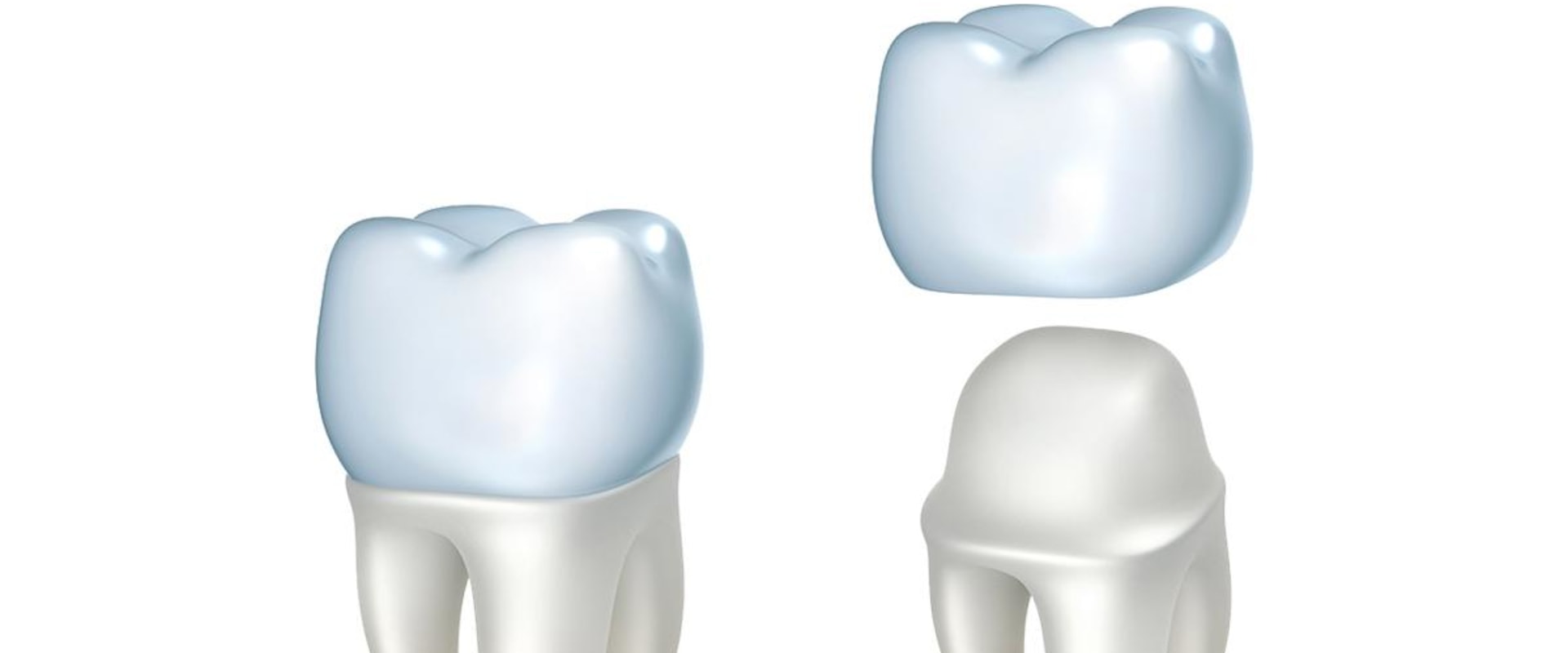 Same Day Crowns