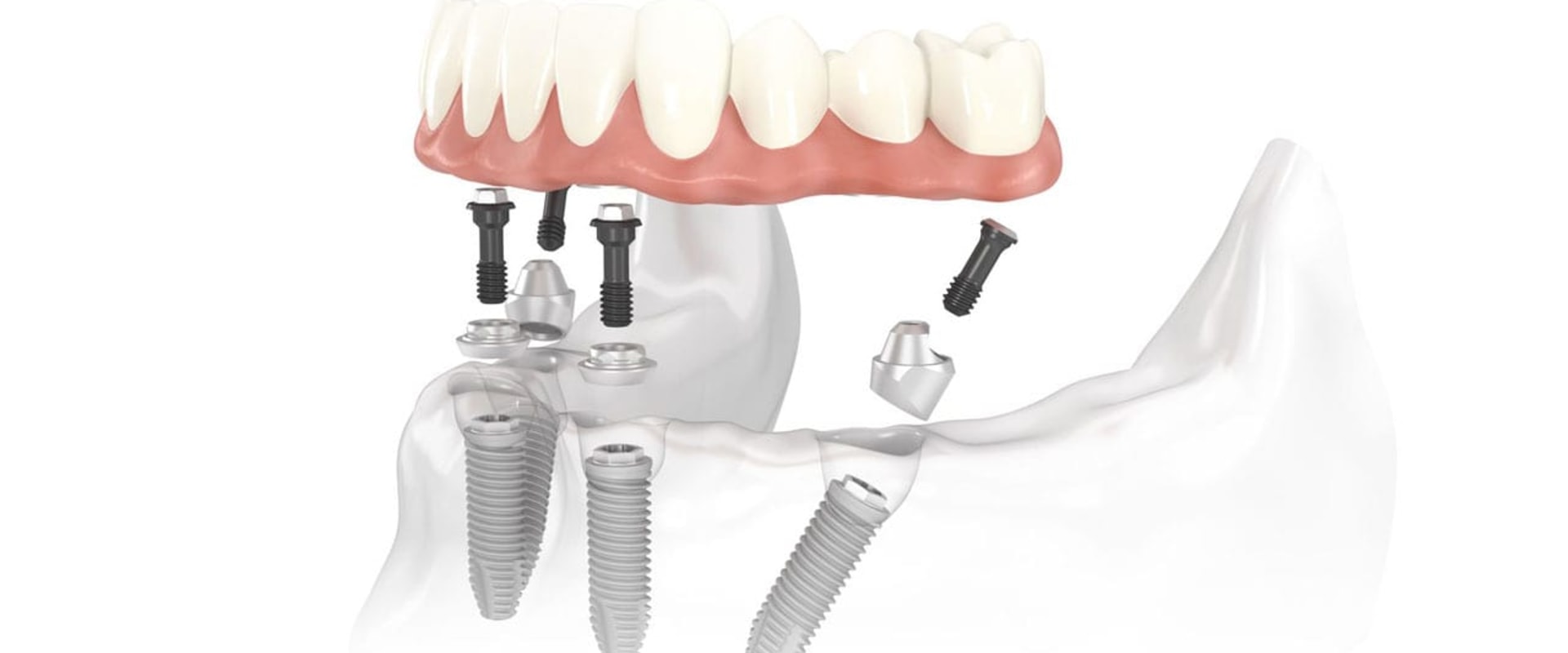 Dental Implants: Everything You Need to Know