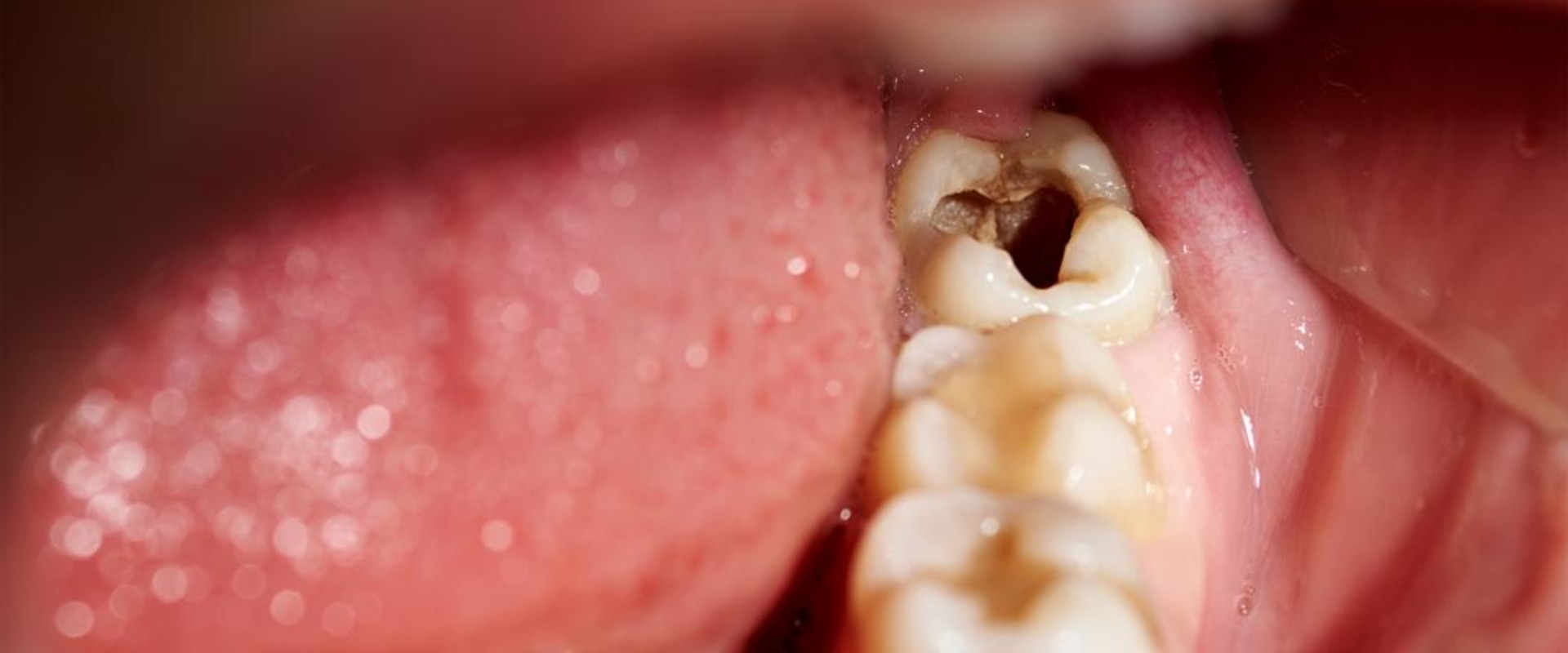 Severe Tooth Decay or Infection: Causes, Symptoms, and Treatment