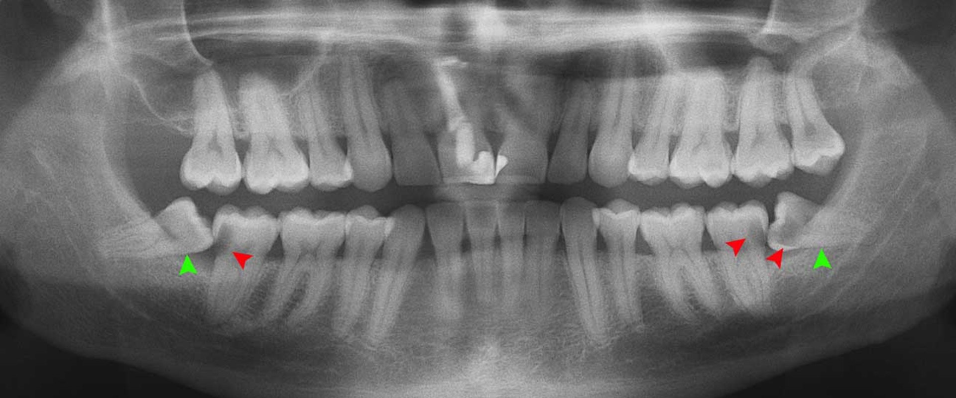 Everything You Need to Know About Surgical Extraction of Impacted Teeth