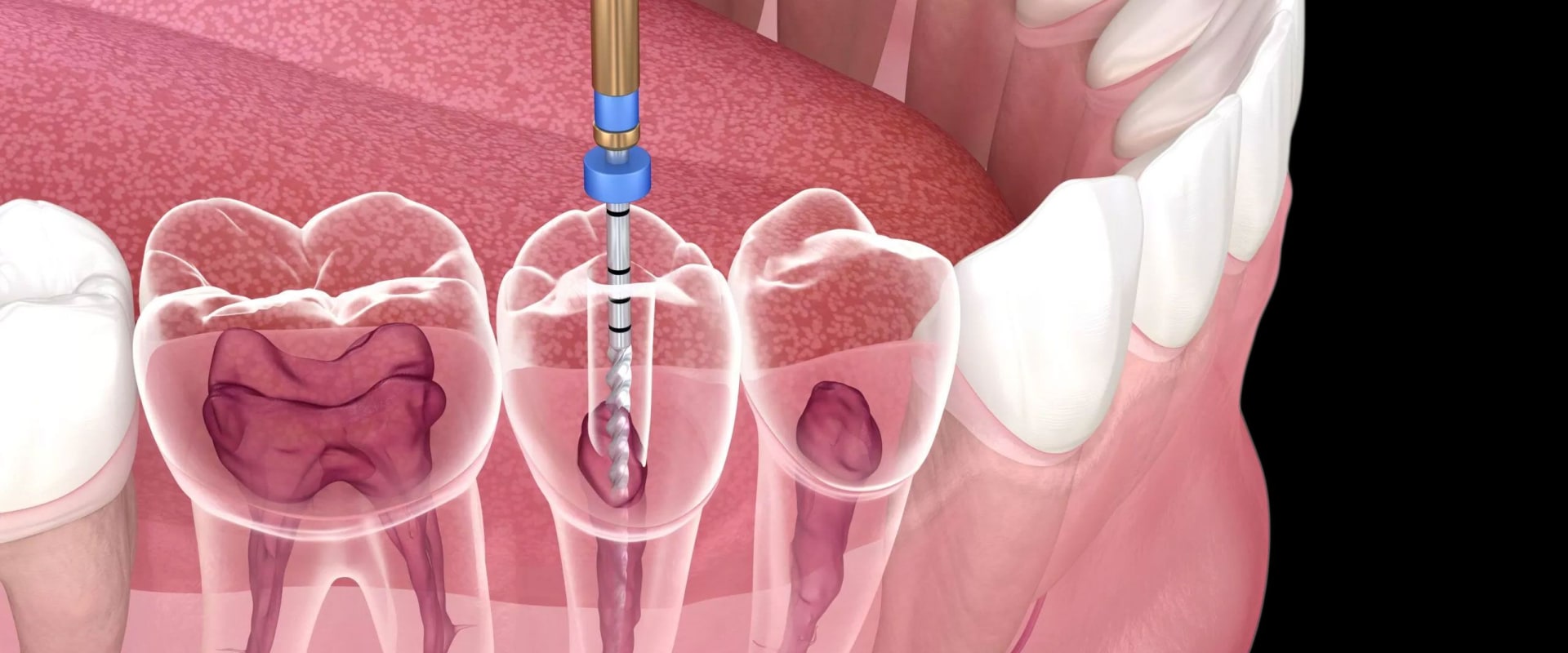 Root Canals: Explaining the Procedure and Benefits