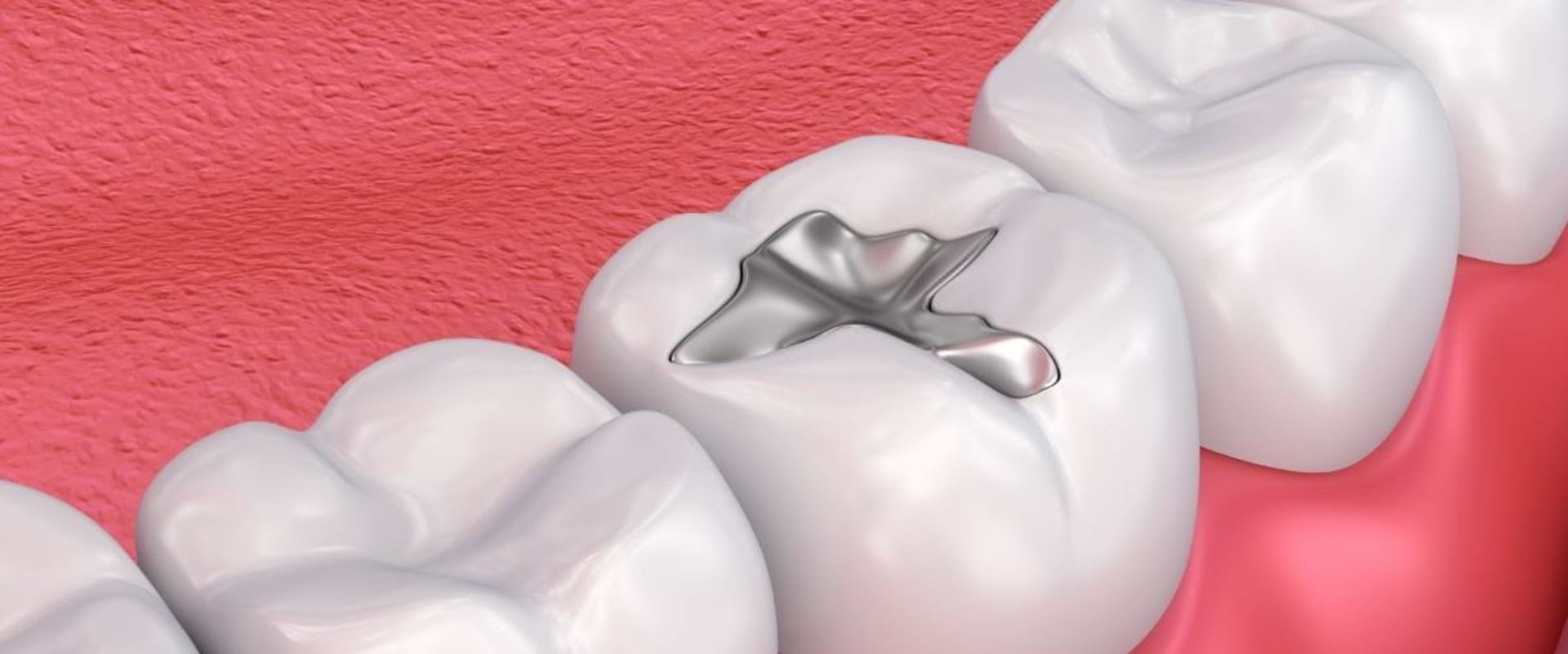 Filling the Inside of the Tooth