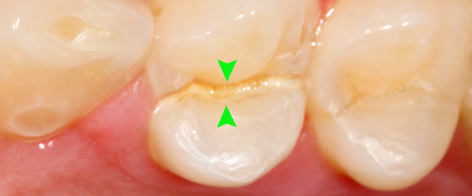 Everything you need to know about fractured or cracked tooth