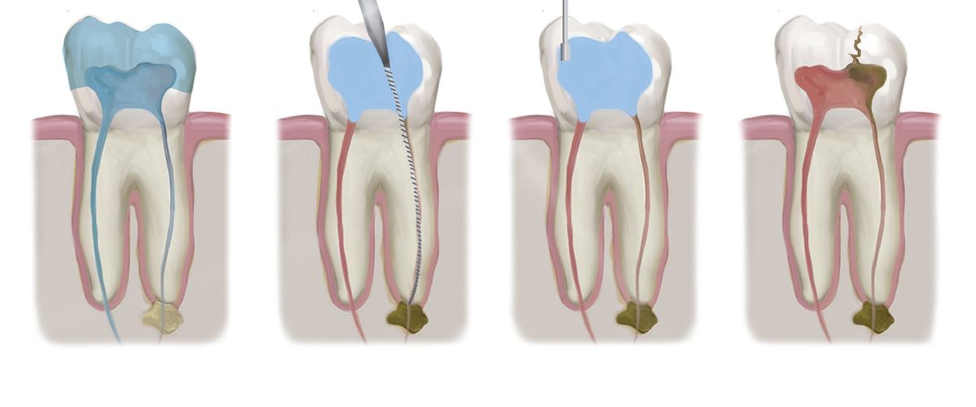 Root Canals: A Comprehensive Overview