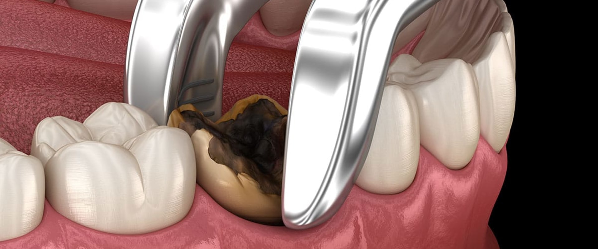 Simple Tooth Extraction: All You Need To Know