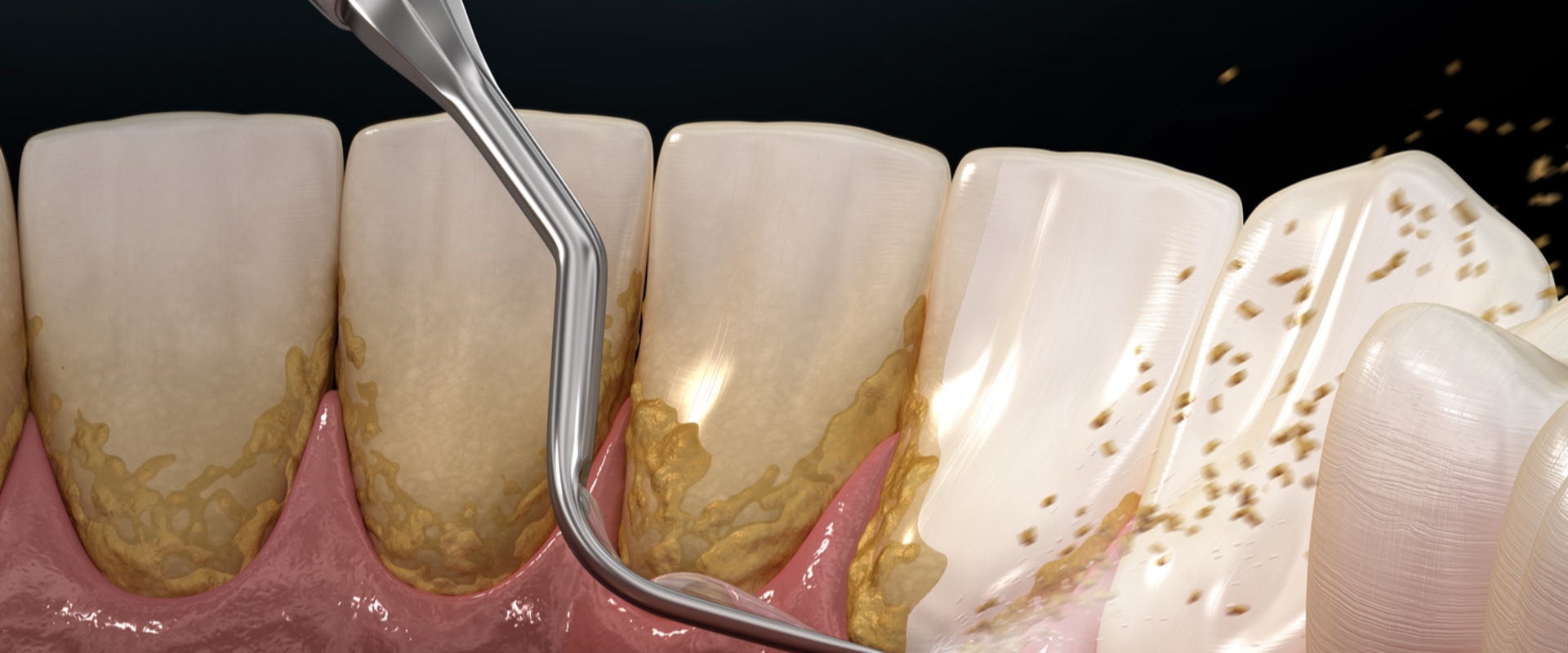 Scaling and Root Planing: Everything You Need To Know