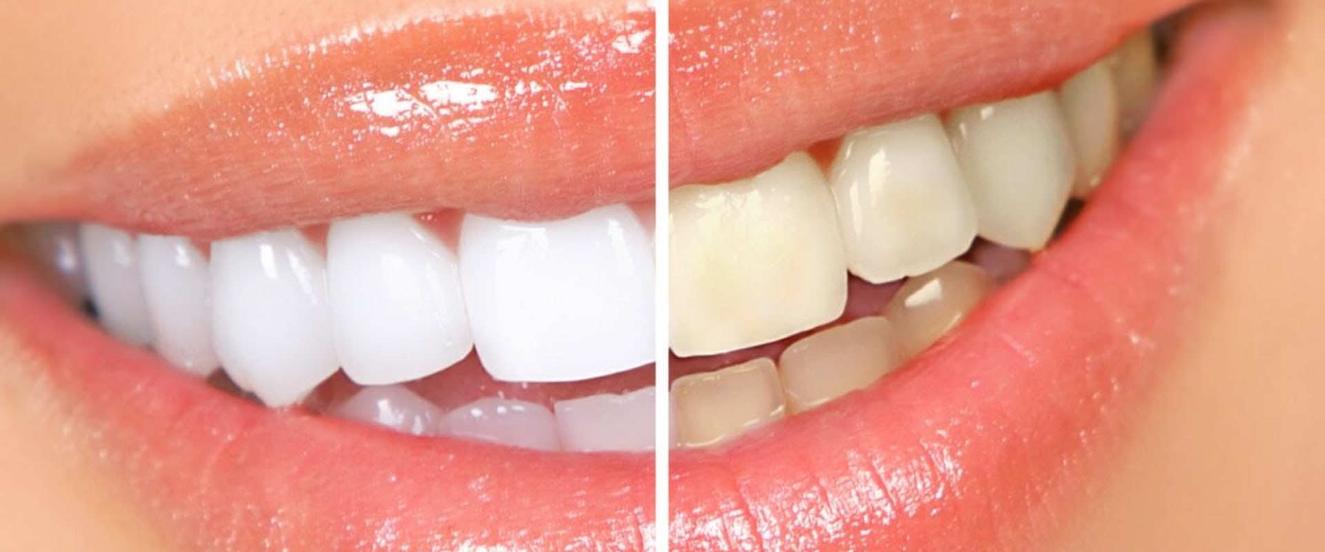 Teeth Whitening: A Comprehensive Overview