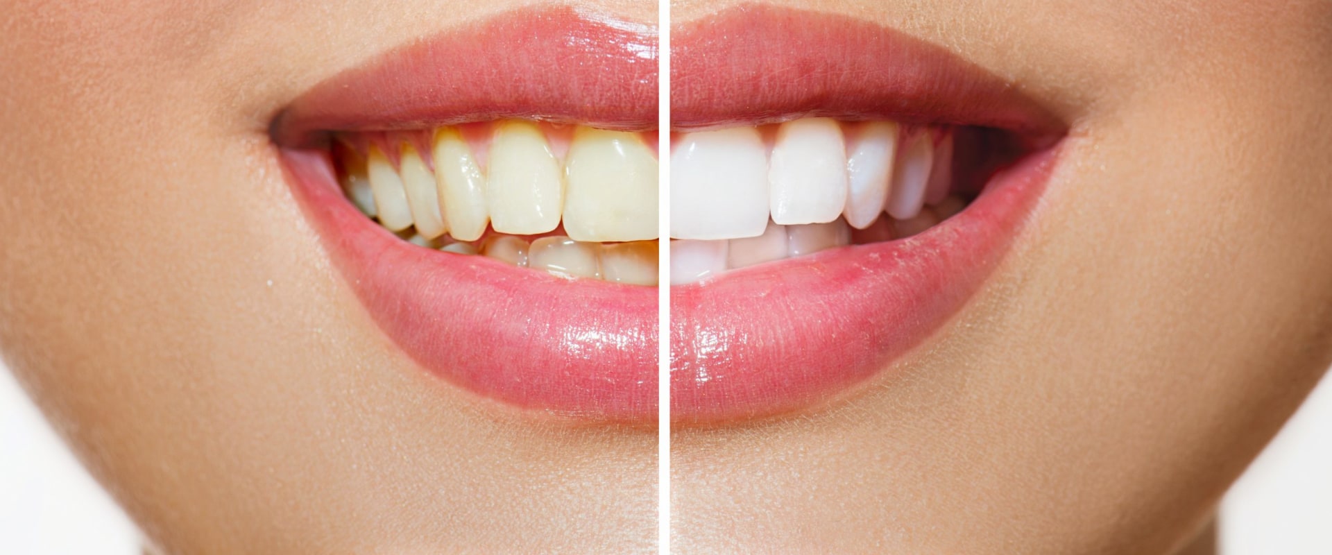 Laser Teeth Whitening Treatments: An In-Depth Look