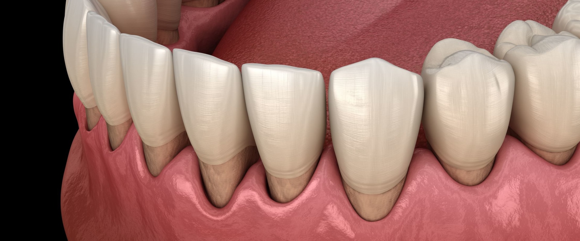 Gum Surgery: A Comprehensive Overview