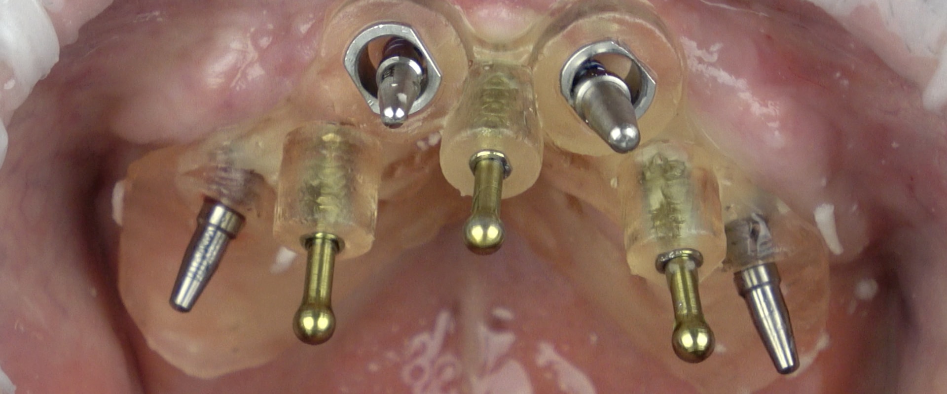 Placement of Crowns: A Comprehensive Guide