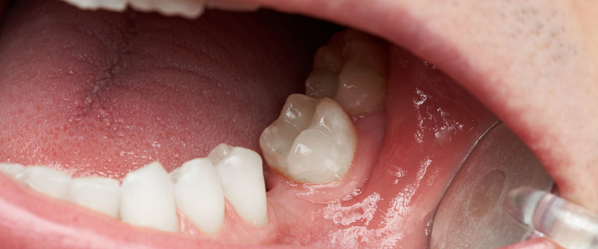 Missing Teeth: Causes, Treatment, and Prevention