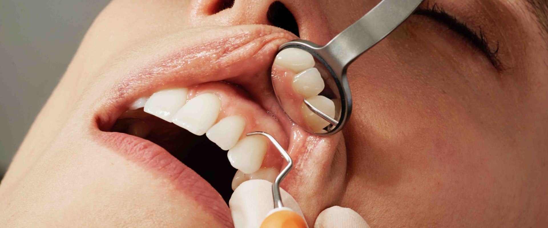 Veneers: An Overview of a Popular Cosmetic Dentistry Procedure