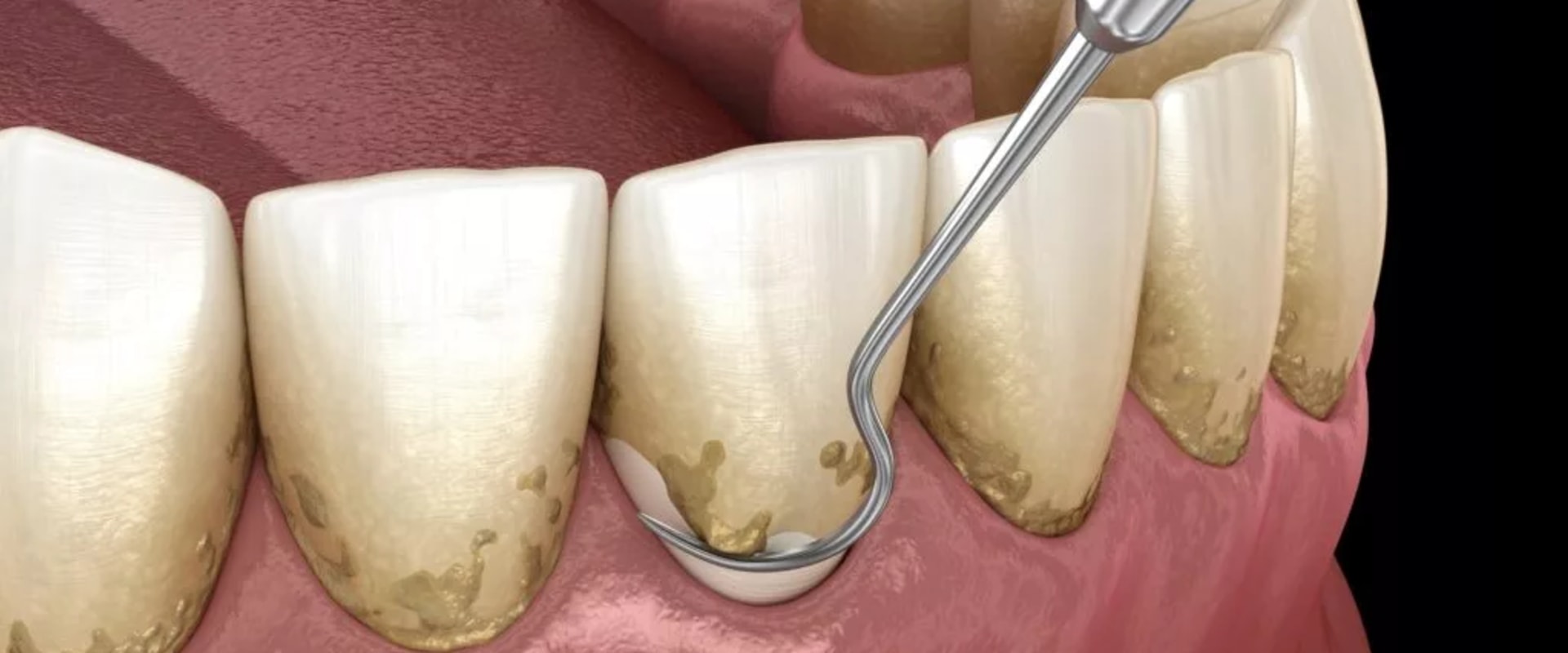 Advanced Gum Disease (Periodontal Disease)