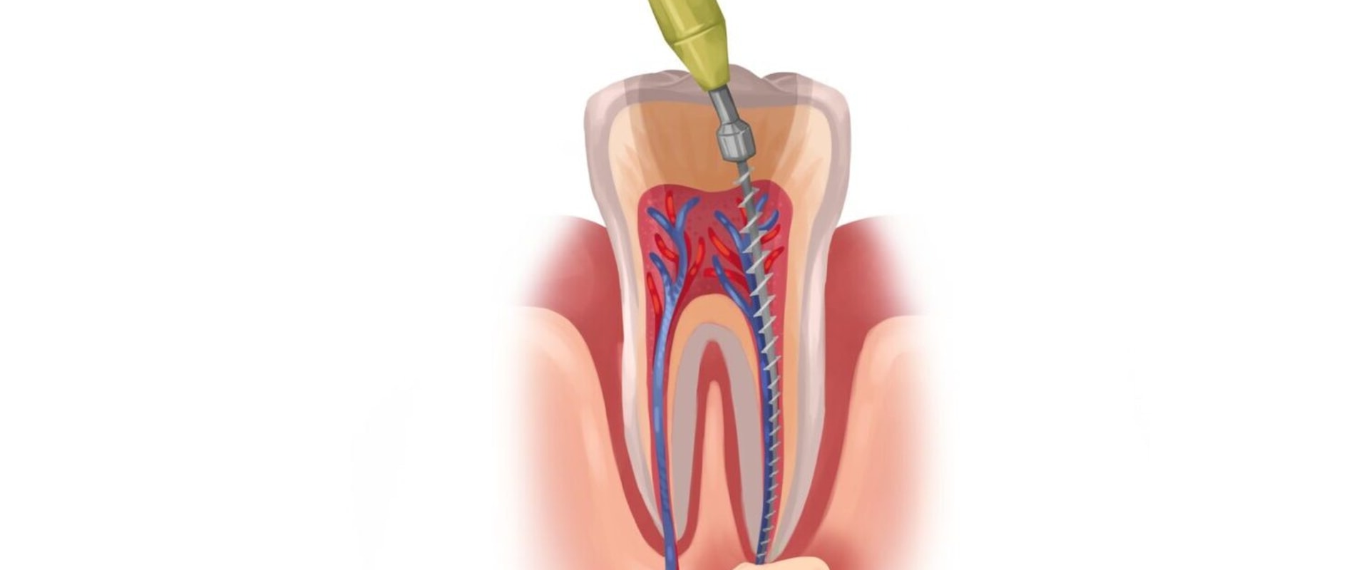 Eating after a Root Canal Treatment