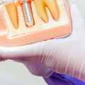 The Basics of Endosteal Implants