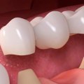 Placement of Abutment: A Comprehensive Overview