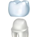 Same Day Crowns