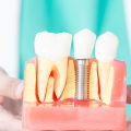 Everything You Need to Know About Dental Implants
