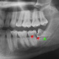 Everything You Need to Know About Surgical Extraction of Impacted Teeth