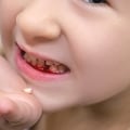 Managing Pain After an Extraction: A Primer