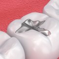Filling the Inside of the Tooth