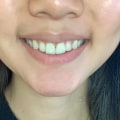 Teeth Whitening with Toothpaste and Mouthwash