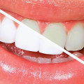 Take-home Teeth Whitening Treatments: A Comprehensive Overview