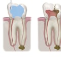 Root Canals: A Comprehensive Overview