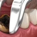 Simple Tooth Extraction: All You Need To Know