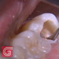 Cleaning the Inside of the Tooth: A Complete Overview