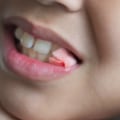 Caring for a Wound After an Extraction: A Guide