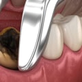 The Basics of Tooth Extractions