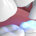 Fillings and Dental Inlays: A Comprehensive Overview
