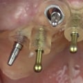 Placement of Crowns: A Comprehensive Guide