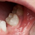 Missing Teeth: Causes, Treatment, and Prevention