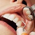 Veneers: An Overview of a Popular Cosmetic Dentistry Procedure