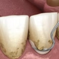 Advanced Gum Disease (Periodontal Disease)