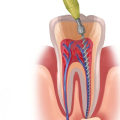 Eating after a Root Canal Treatment