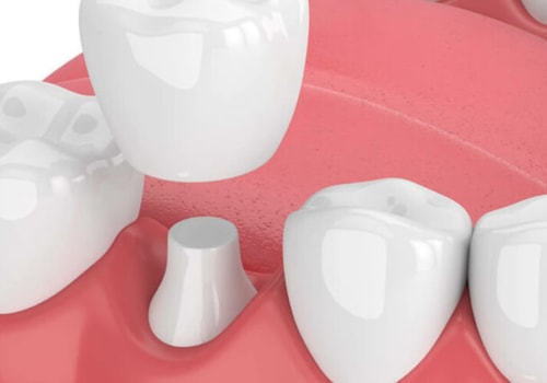 Crowns and Bridges: An Overview