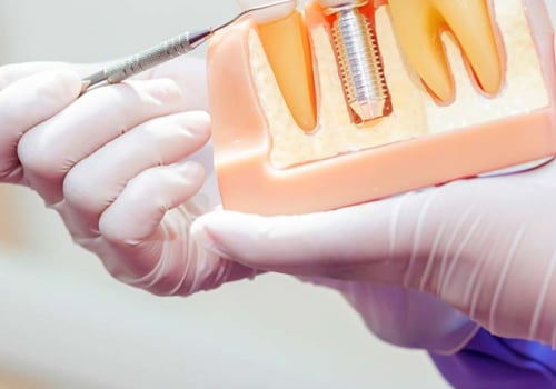 The Basics of Endosteal Implants