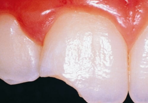 Everything You Need to Know About Injury or Trauma to the Tooth