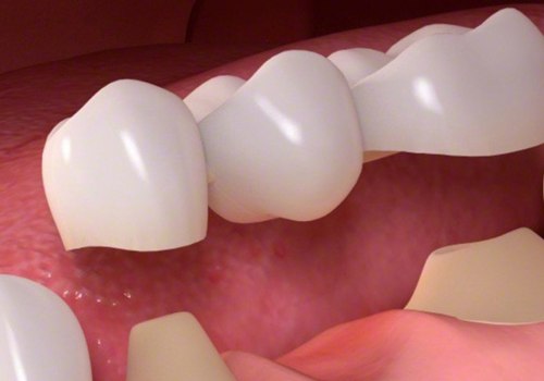 Placement of Abutment: A Comprehensive Overview