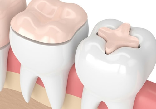 Everything You Need to Know About Fillings and Dental Inlays