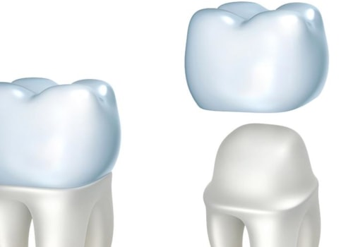 Same Day Crowns