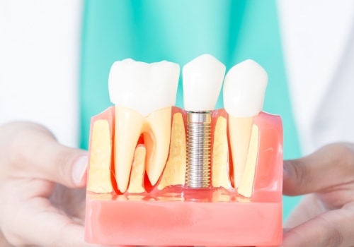 Everything You Need to Know About Dental Implants